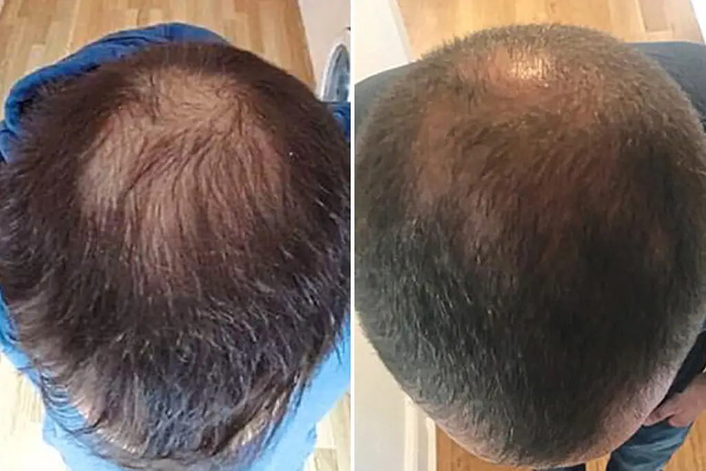 hair-loss-treatment